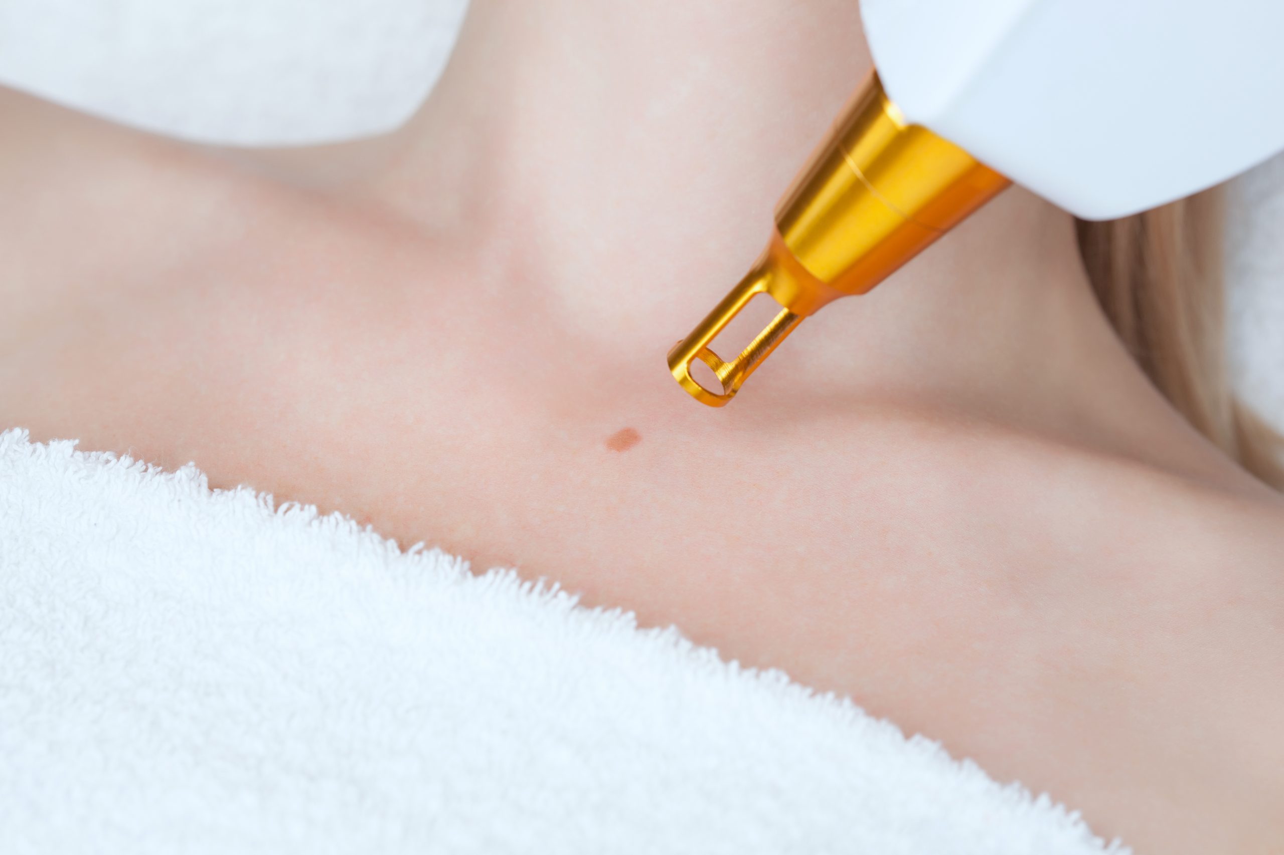 Laser mole removal on a woman's neck in a beauty salon ほくろ除去