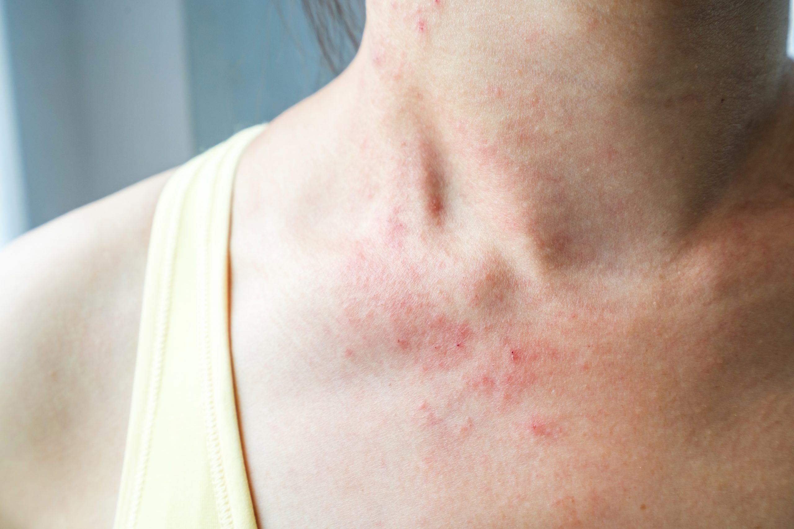 Young woman has skin rash itch on neck かぶれ
